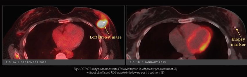  Case study: Remission of metastatic breast cancer may have been due to use of cannabis oil and magic mushrooms