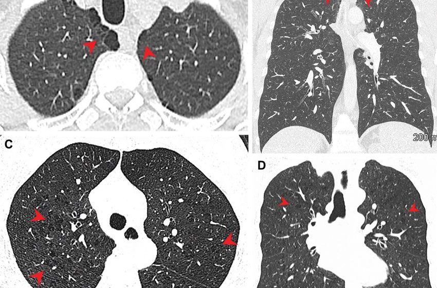  Imaging study: Marijuana smokers show higher rates of emphysema, airway diseases than tobacco smokers