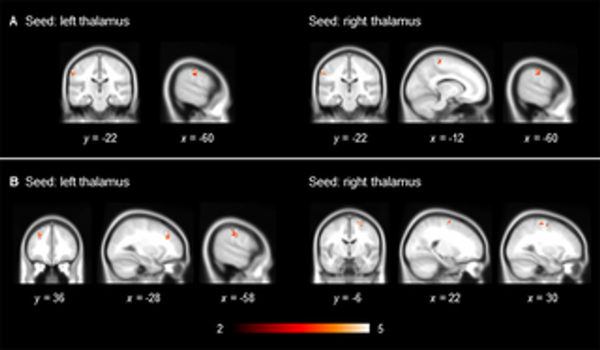  Thalamocortical functional connectivity and cannabis use in men with childhood attention-deficit/hyperactivity disorder