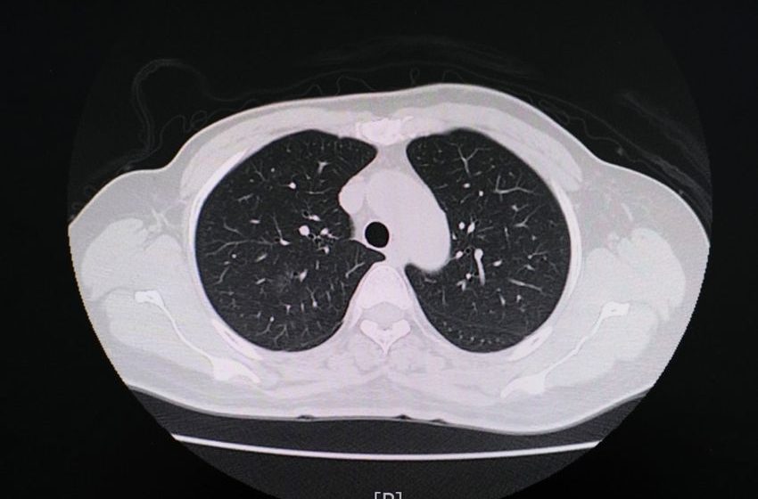  Smoking marijuana damages the lungs more than tobacco