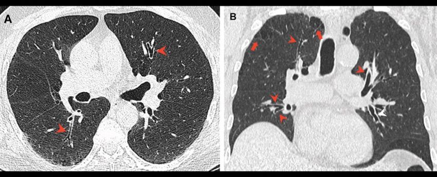  Smoking Cannabis Could Harm Your Lungs More Than Tobacco, Study Finds