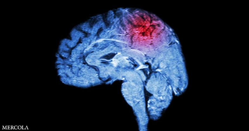  Even Mild Head Injuries Increase Risk for Parkinson’s Disease