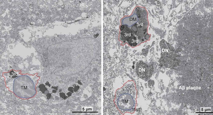  Scientists Make Key Alzheimer’s Breakthrough Identifying Cellular Stress-Related Mechanism Driving the Disease